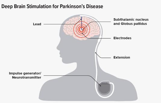 How Subthalamic Nucleus Deep Brain Stimulation Improves Anxiety in Parkinson’s Disease Patients