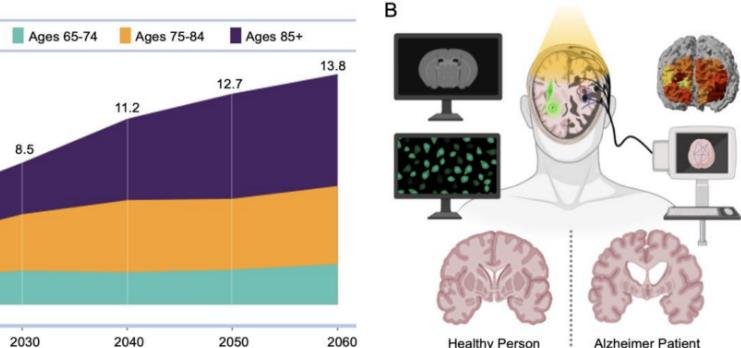 Neuroimaging techniques can improve early and accurate diagnosis of dementia, study finds