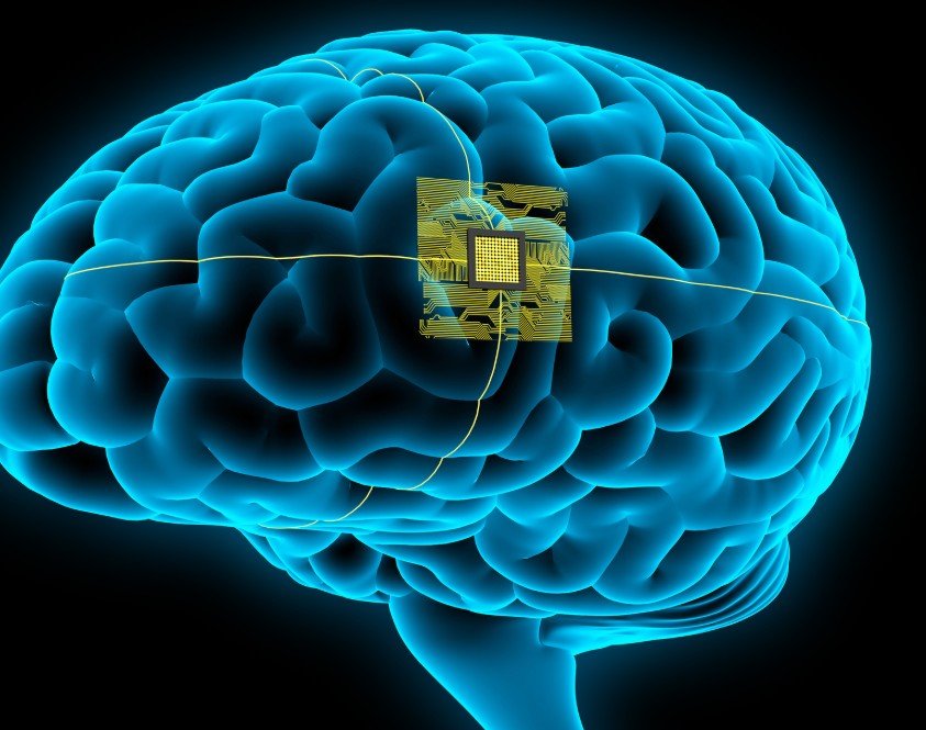 brain implant technology